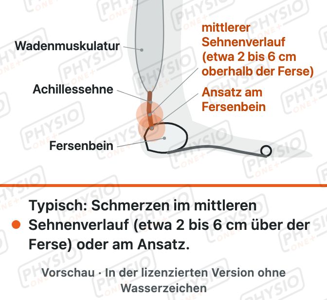 Vorschau: Achillessehne