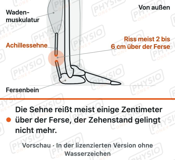 Vorschau: Riss der Achillessehne