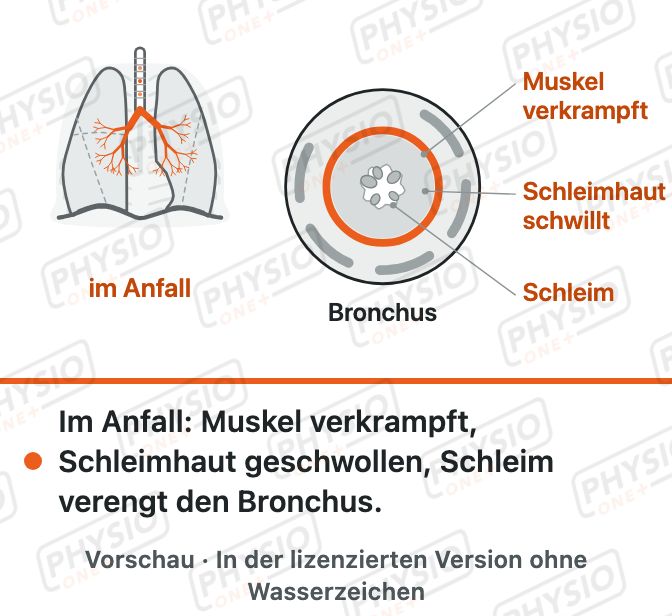 Vorschau: Asthma