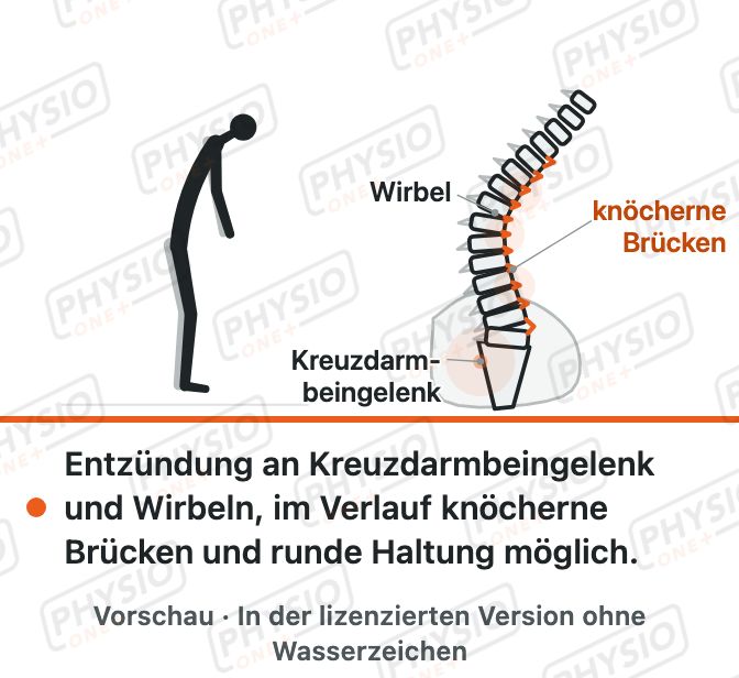 Vorschau: Morbus Bechterew