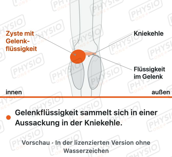 Vorschau: Baker-Zyste in der Kniekehle