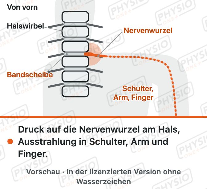 Vorschau: Bandscheibenvorfall der Halswirbelsäule