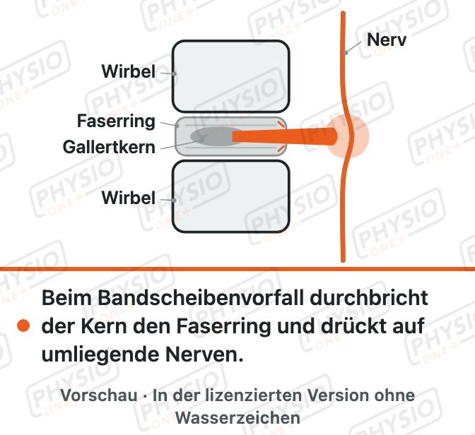 Vorschau: Bandscheibenvorfall