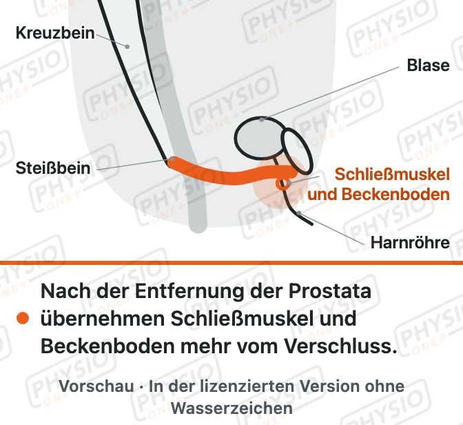 Vorschau: Beckenboden nach Prostata-OP