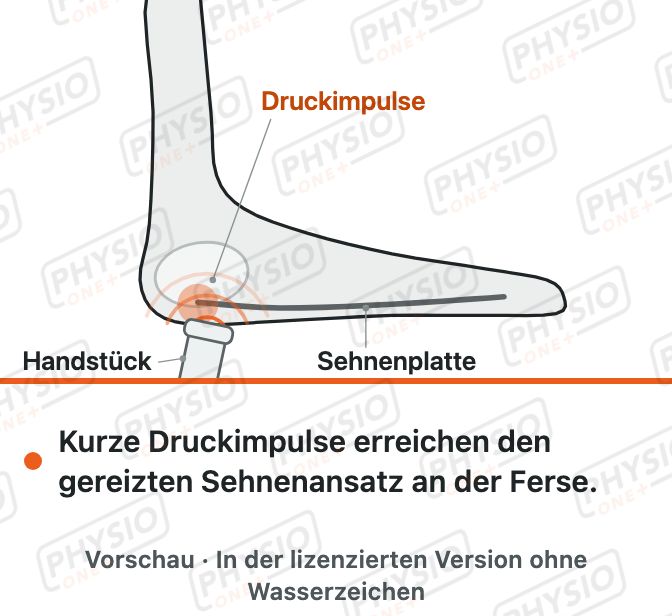 Vorschau: Stoßwellentherapie