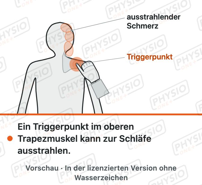 Vorschau: Behandlung von Triggerpunkten