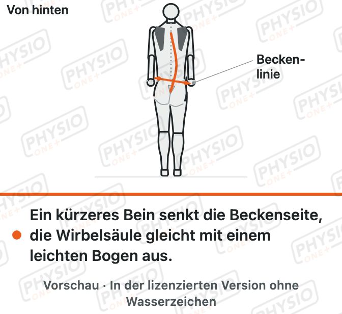 Vorschau: Unterschiedliche Beinlänge und Beckenstand