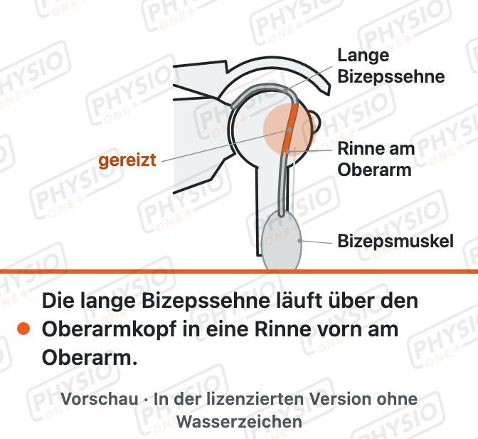 Vorschau: Die lange Bizepssehne