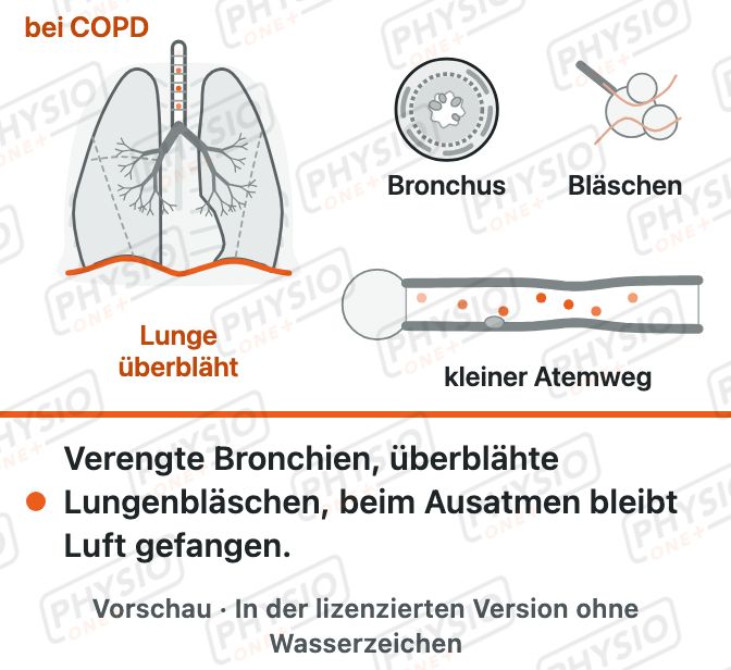 Vorschau: COPD: verengte Atemwege