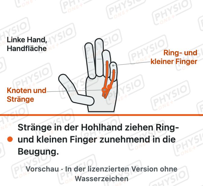 Vorschau: Stränge in der Handfläche (Dupuytren-Kontraktur)
