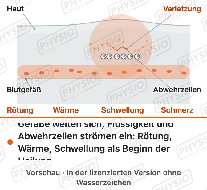 Vorschau: Entzündung: Rötung, Wärme, Schwellung