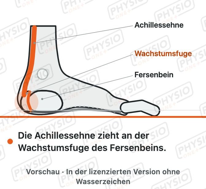 Vorschau: Fersenschmerz im Wachstum