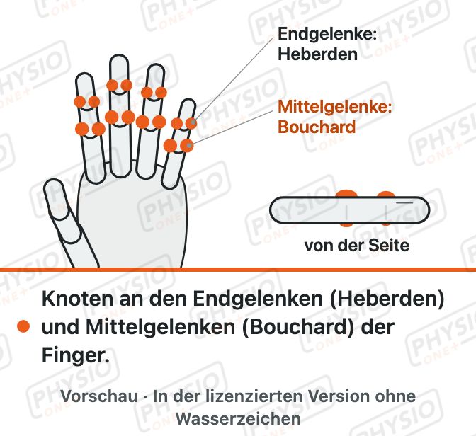 Vorschau: Arthrose der Fingergelenke