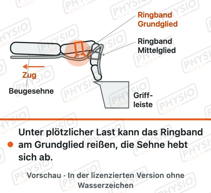 Vorschau: Fingerverletzung beim Klettern