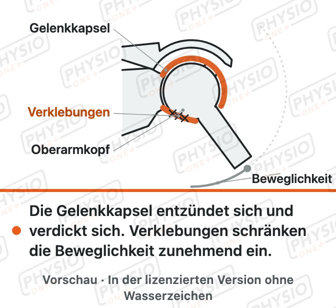 Vorschau: Schultersteife (Frozen Shoulder)