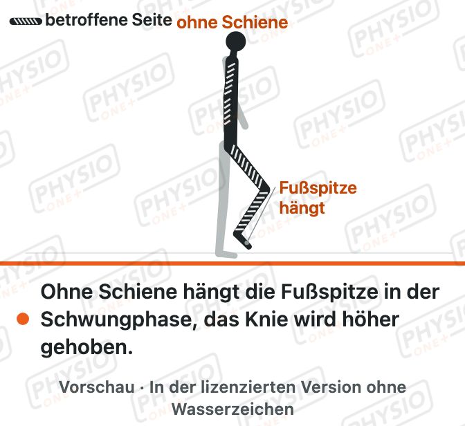 Vorschau: Fußheberschwäche und Fußheberorthese