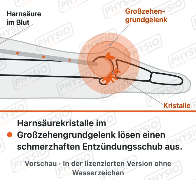 Vorschau: Gicht