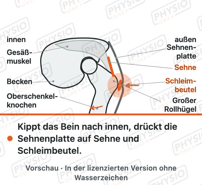 Vorschau: Schmerz an der Hüftaußenseite
