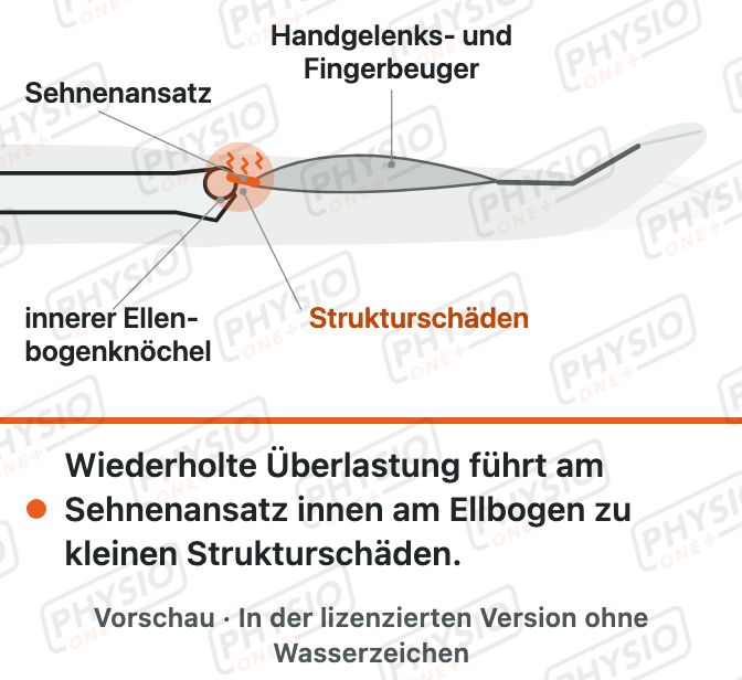Vorschau: Golferellenbogen