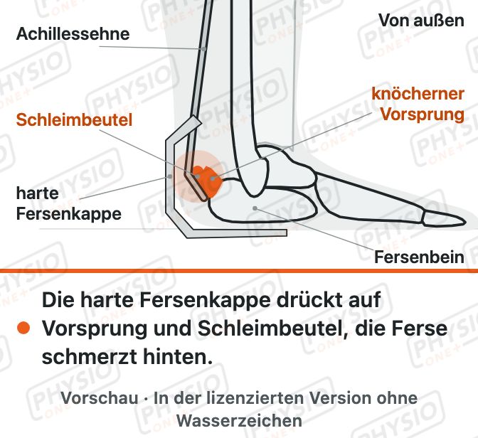 Vorschau: Knöcherner Vorsprung an der Ferse