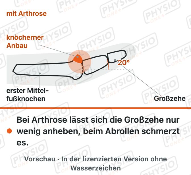 Vorschau: Steifes Großzehengrundgelenk