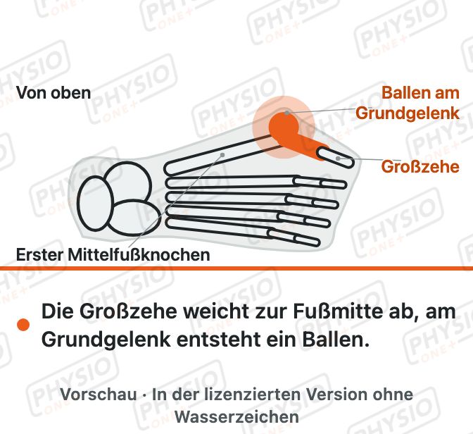 Vorschau: Schiefstand der Großzehe (Hallux valgus)
