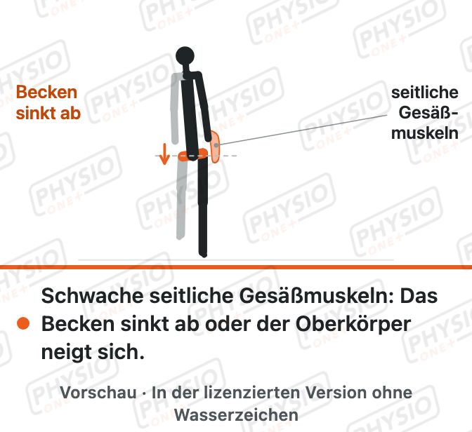 Vorschau: Hinken bei schwacher Hüftmuskulatur