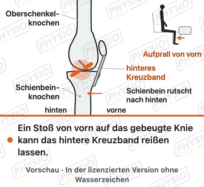 Vorschau: Hinteres Kreuzband