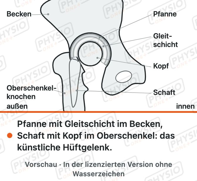 Vorschau: Die Hüftprothese