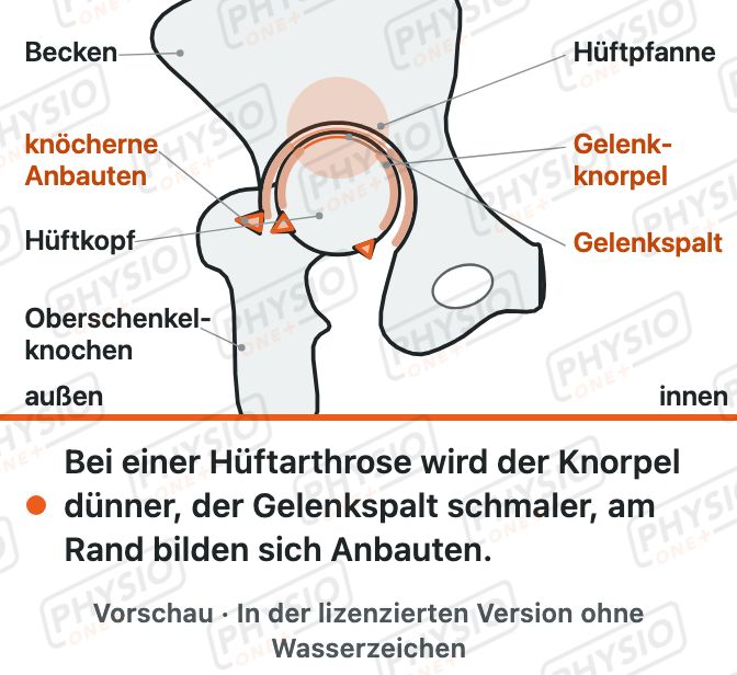 Vorschau: Hüftarthrose