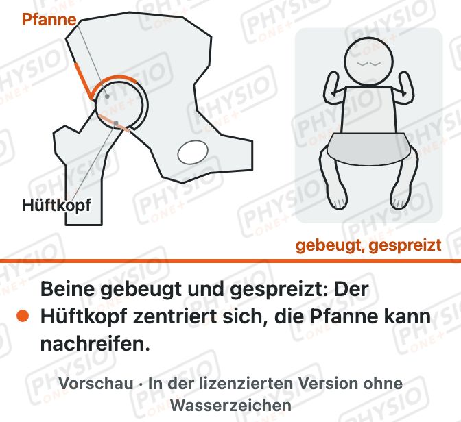 Vorschau: Hüftdysplasie beim Baby