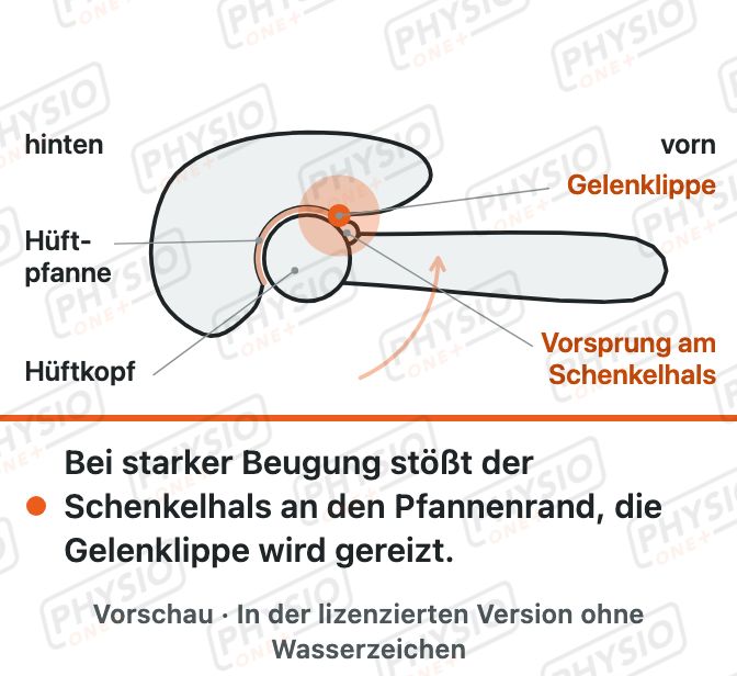 Vorschau: Enge im Hüftgelenk (Hüftimpingement)