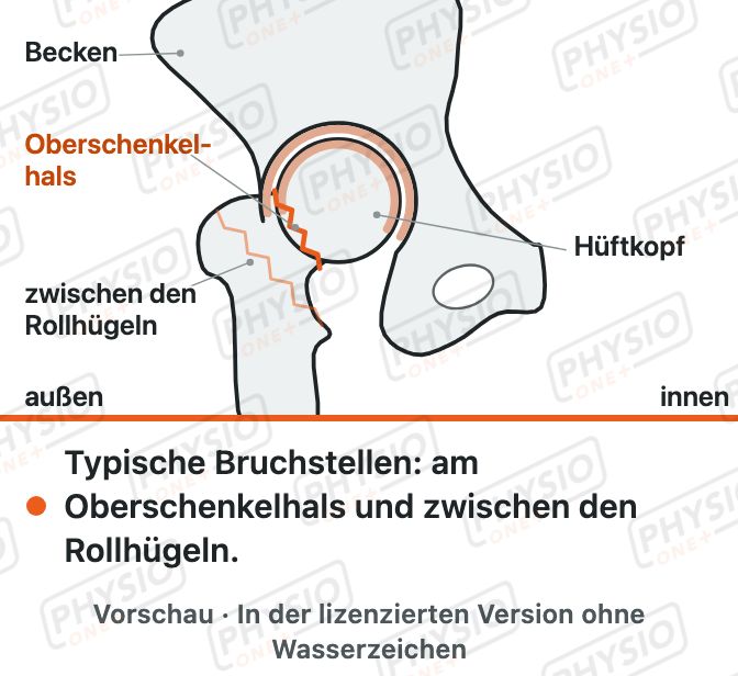 Vorschau: Hüftnaher Oberschenkelbruch