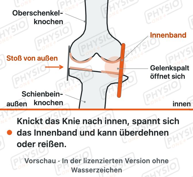 Vorschau: Innenbandverletzung am Knie