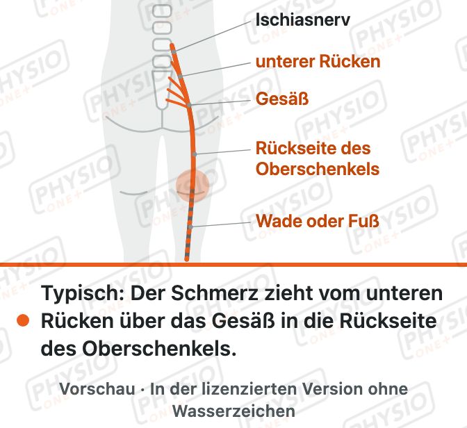 Vorschau: Verlauf des Ischiasnervs