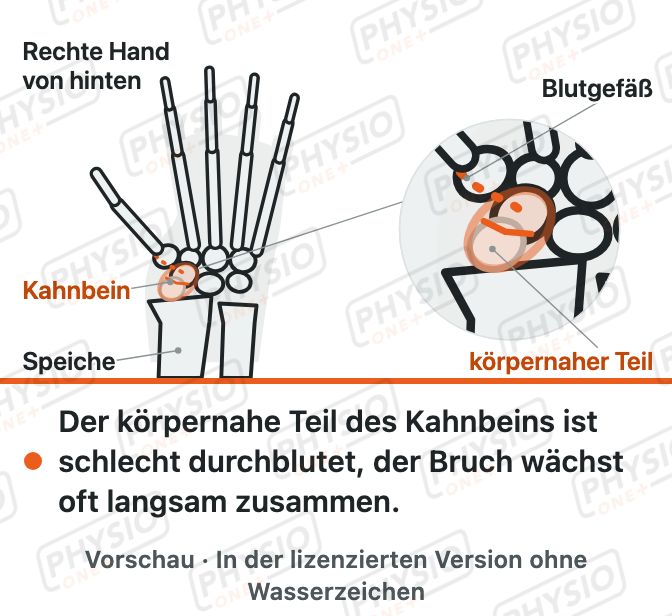 Vorschau: Kahnbeinbruch