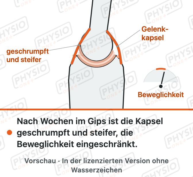 Vorschau: Gelenkkapsel nach Ruhigstellung