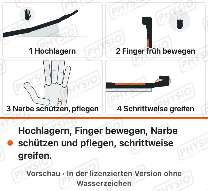 Vorschau: Die Hand nach einer Karpaltunnel-OP