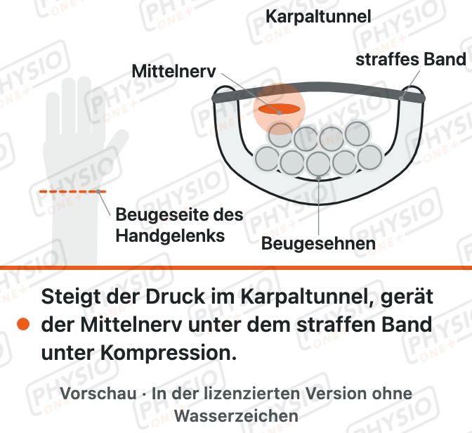 Vorschau: Karpaltunnelsyndrom