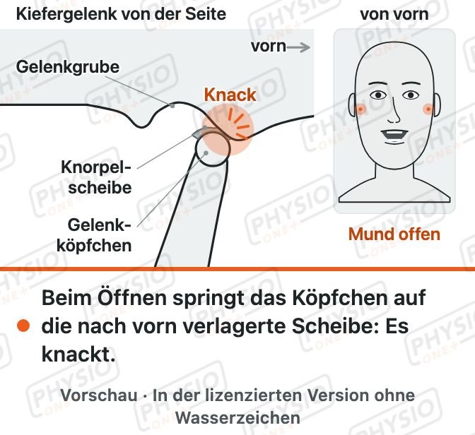 Vorschau: Knacken im Kiefergelenk