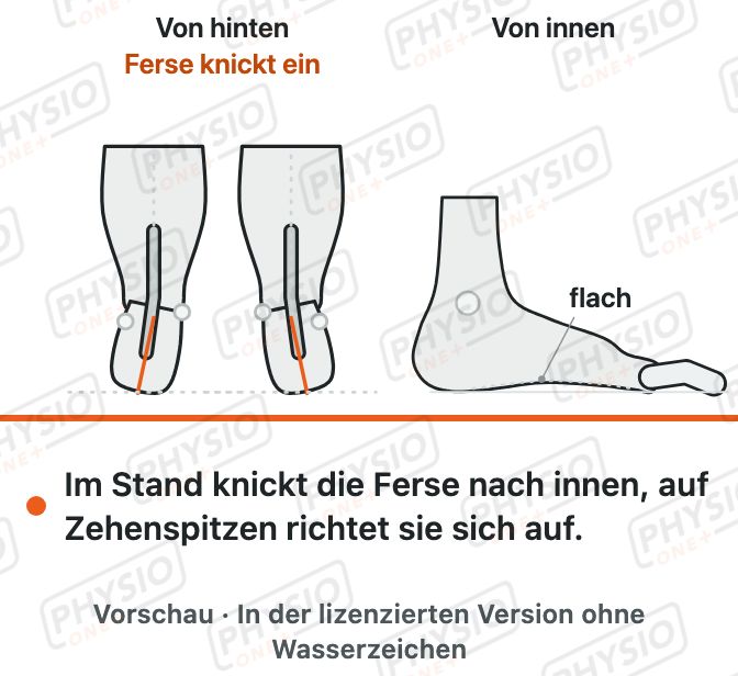 Vorschau: Knick-Senkfuß beim Kind