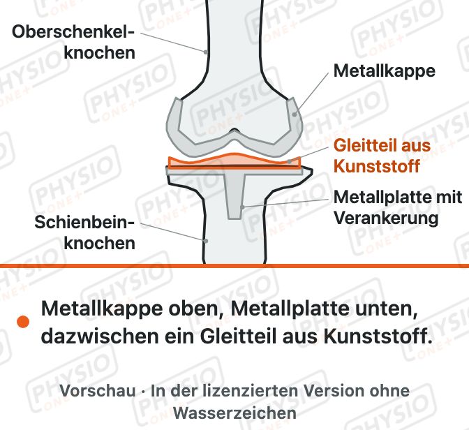 Vorschau: Die Knieprothese