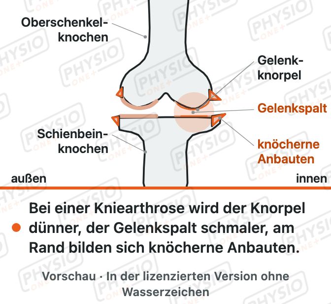 Vorschau: Kniearthrose