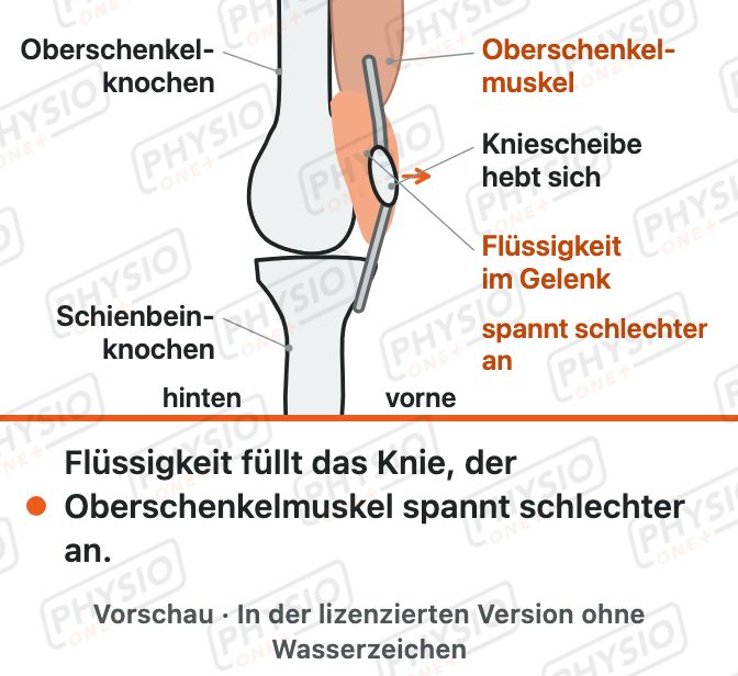 Vorschau: Erguss im Knie