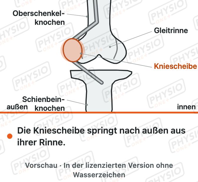 Vorschau: Ausgekugelte Kniescheibe
