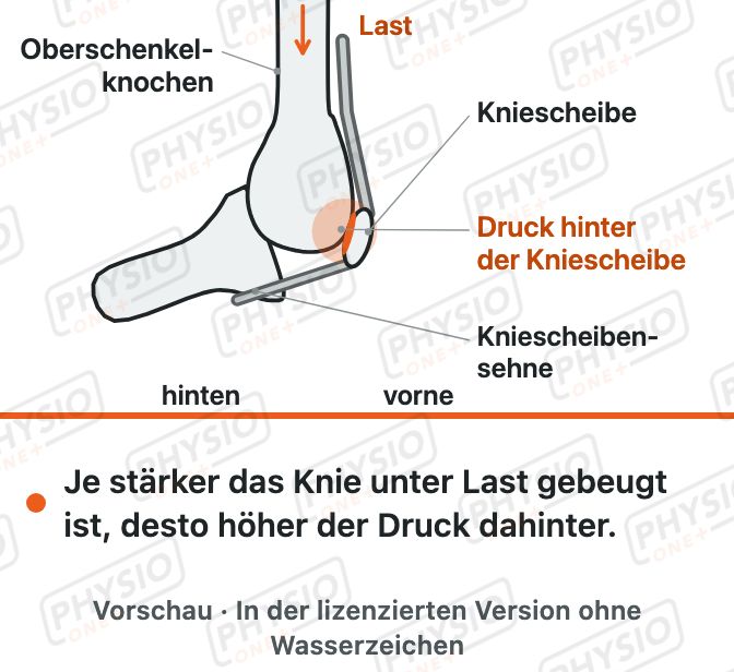 Vorschau: Schmerz hinter der Kniescheibe