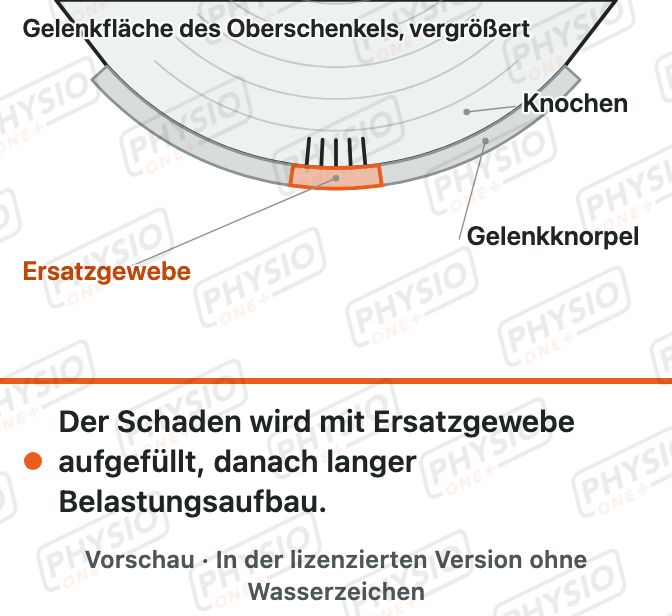 Vorschau: Knorpelschaden im Knie und Knorpel-OP