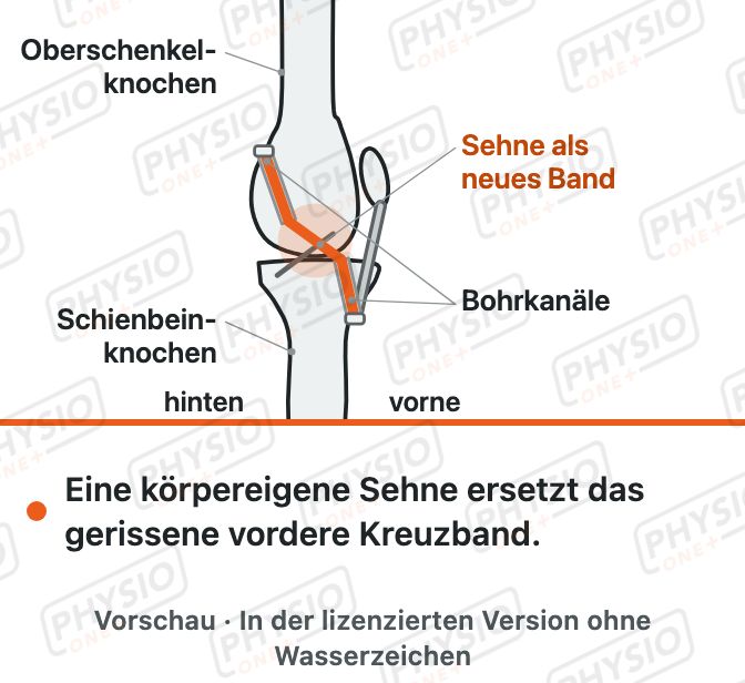 Vorschau: Kreuzbandersatz: Sehne als neues Band