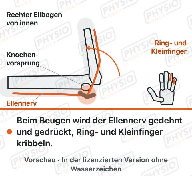 Vorschau: Engpass am Ellennerv
