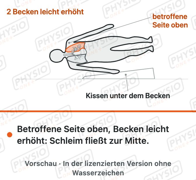 Vorschau: Lagerung zum Sekretabfluss